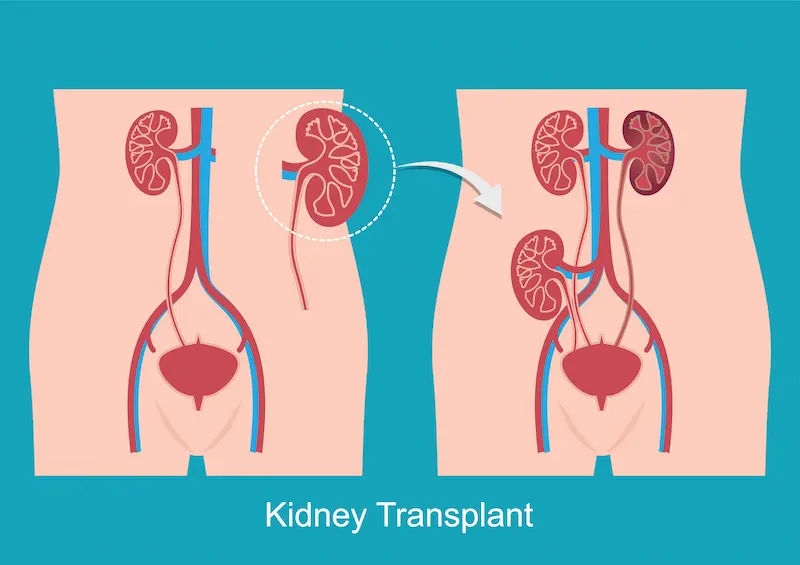 Guide to Kidney Transplant Nephrology